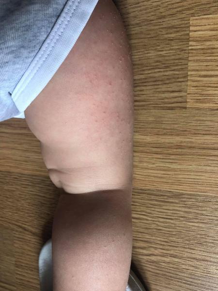 Vyrážky u 7 mesačného dieťaťa