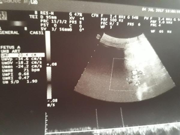 Čo sa dá vyčítať z fotky zo sonografického vyšetrenia?