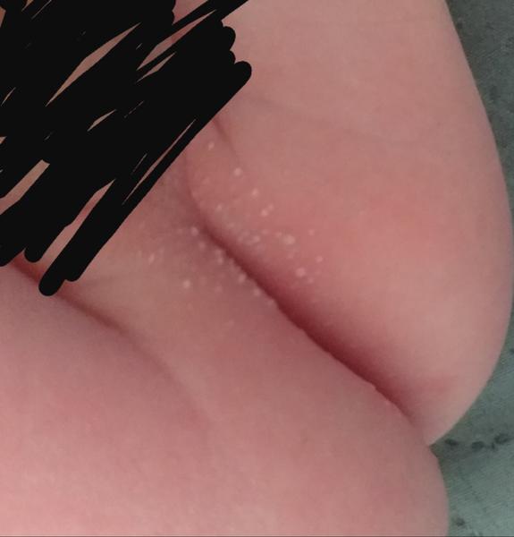 Vyrážky a suchá koža u 3-mesačného bábätka.