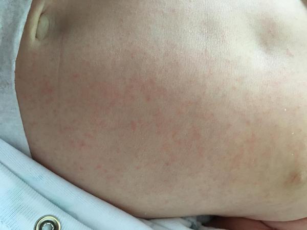 Vyrážky u 6 týždňového bábätka. Čím to môže byť?