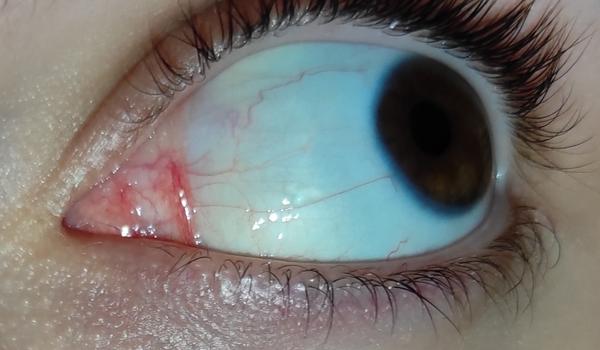 Môžem mať cystu na oku?