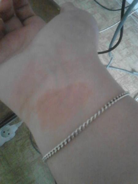 Červený fľak na ruke