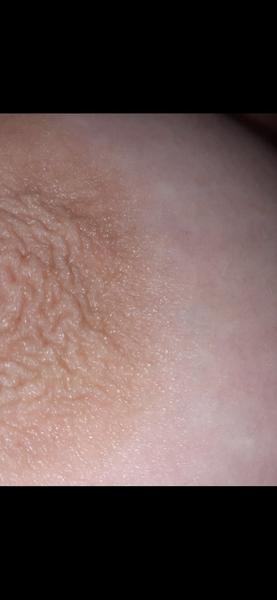 Zvráskavená koža na prsníku