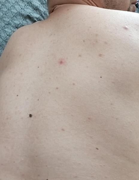 Ako sa zbaviť akné na chrbte?