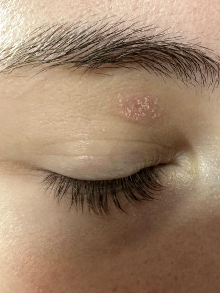 Ekzém nad okom: Ako ho liečiť bez bolesti?