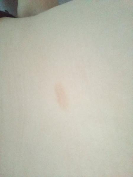 Aký fľak mám na bruchu?