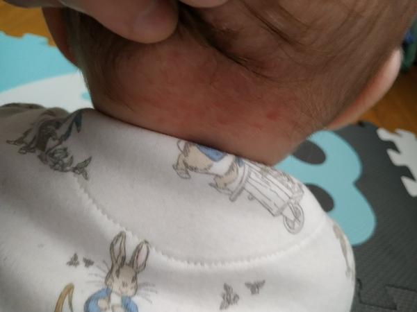 Červené fľaky pod vláskami