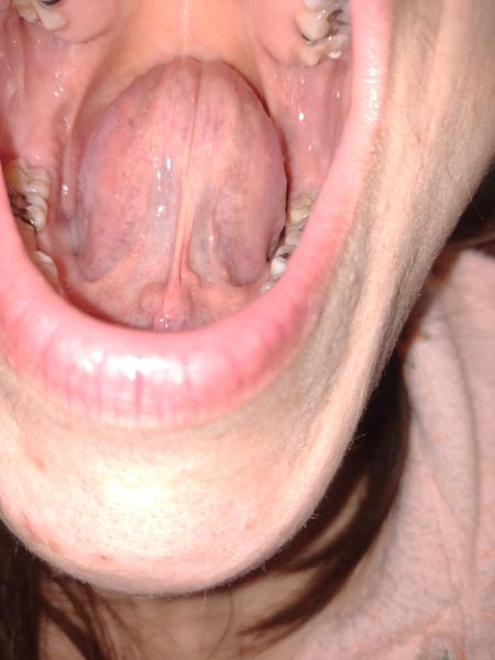 Opuchnuté slinné žľazy: Čo môže byť príčinou?