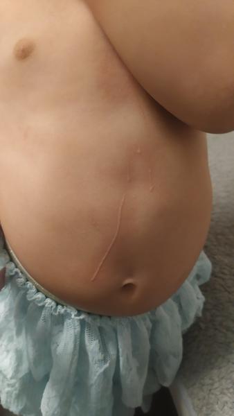 Vystúpené čiary na koži u trojročného dieťaťa