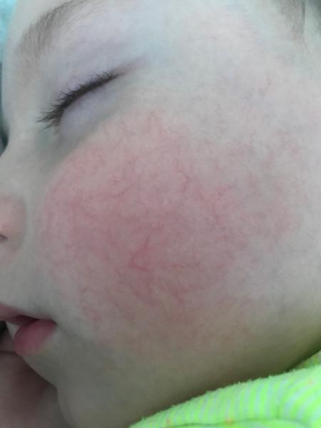 Rosacea a kuperóza u detí: Ako pomôcť?