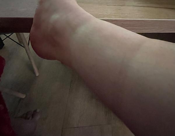 Otlačené členky od ponožiek: Čo je príčinou?