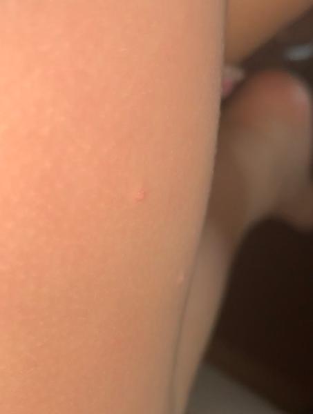 Aké vyrážky má môj syn na vnútornej strane stehien?