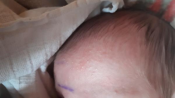 Je to alergia/exém u 2-týždňového bábätka??