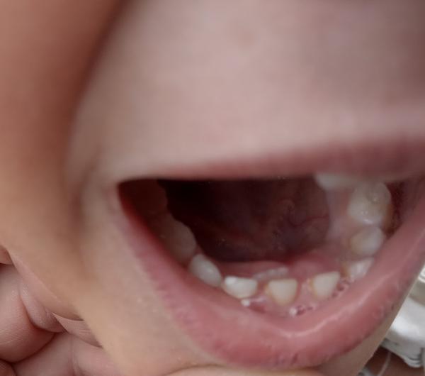 Ako postupovať, keď mliečny zub ešte nevypadol a druhý je už vonku?