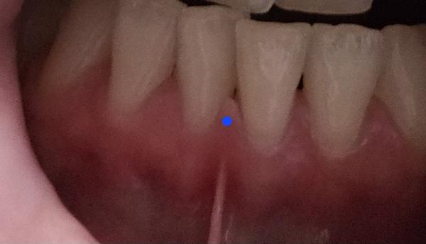 Čo sa mi deje s ďasnom?