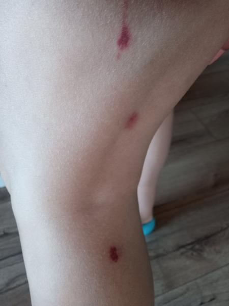 Aký kožný problém mám na nohe?