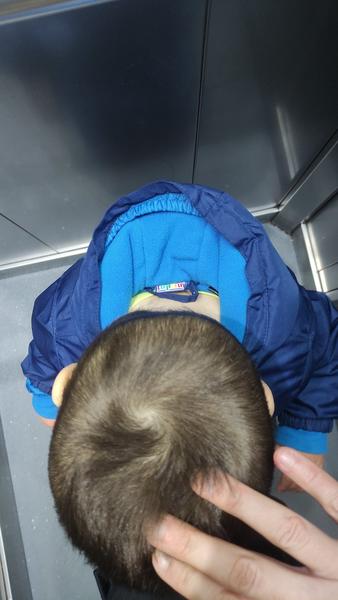 Je v poriadku takáto mierna asymetria lebky u skoro 2-ročného dieťaťa?