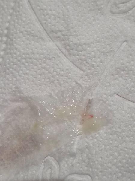 Pretrvávajúci dráždivý kašeľ a krv v hliene počas tehotenstva