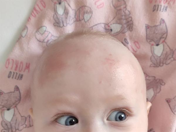 Prečo 6 mesačnej dcérke vznikajú suché začervenané fľaky?