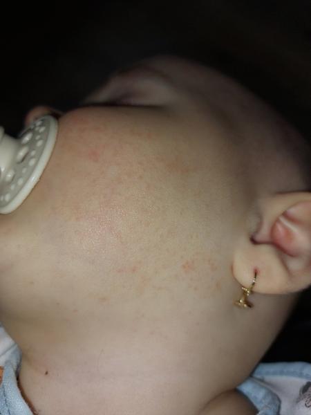 Je to alergia na karfiol alebo inú zeleninu?