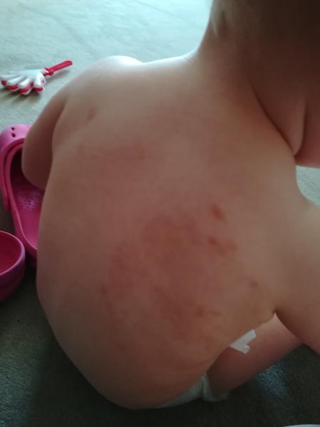 Čo to môže byť? Červené miesta na chrbátiku