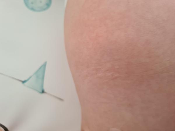 Pásový opar alebo len ekzém