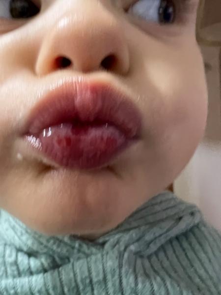 Vyrážka na spodnej pere