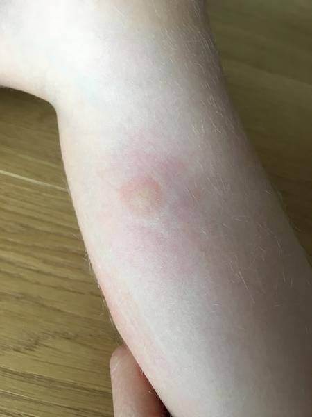 Aké vyrážky má moja 4,5 ročná dcérka?