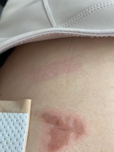 Ako postupovať pri reakcii na domácu liečbu vyrážky?