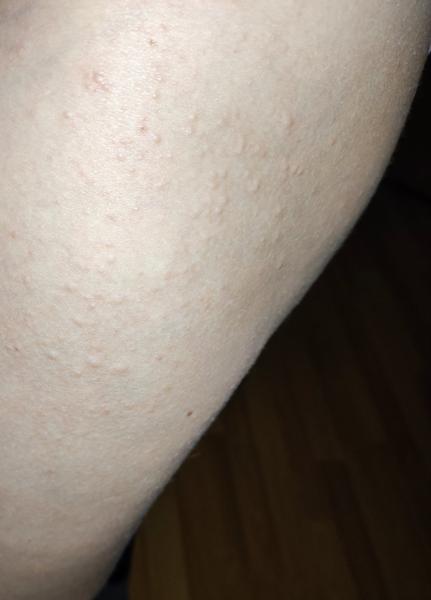 Vyrážky a svrbenie v 13. týždni tehotenstva: Ako si pomôcť?