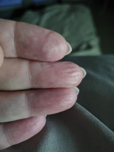 Prečo sa mi zvráskavujú končeky prstov?