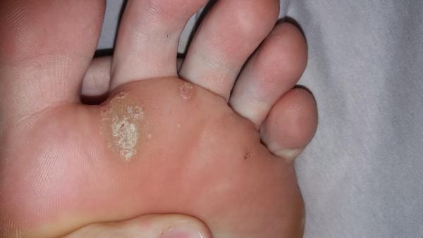 Sú to kurie oká alebo bradavice?