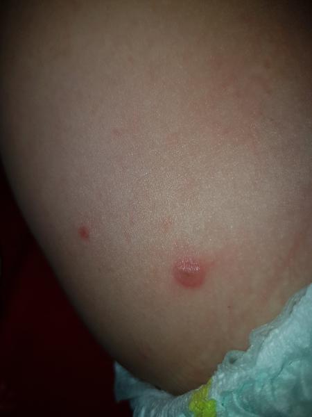 Sú to kiahne alebo alergia?