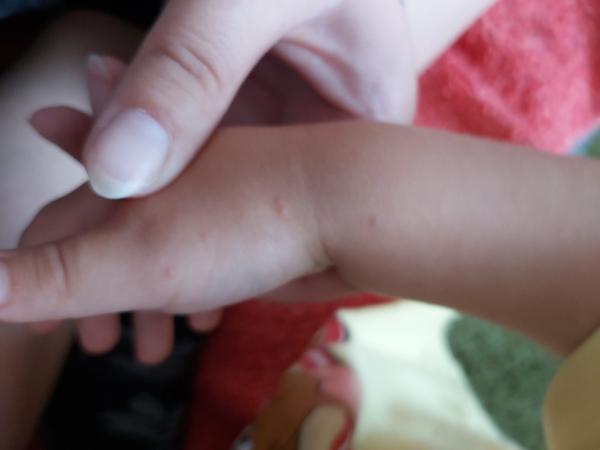 Aké vyrážky má moje dvojročné dieťa?