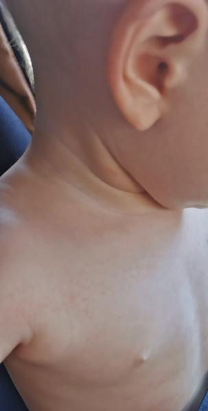 Aké vyrážky sa objavili u môjho syna?