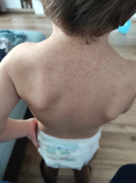 Deti majú podivné symptómy. Čo to môže byť?