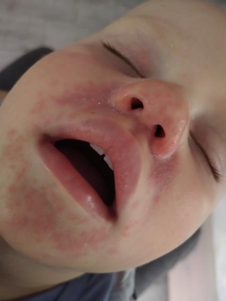 Z čoho má 1,5-ročný syn podráždenú pokožku v oblasti úst a nosa?