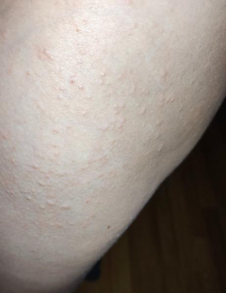 Vyrážky a svrbenie v 13. týždni tehotenstva: Ako si pomôcť?