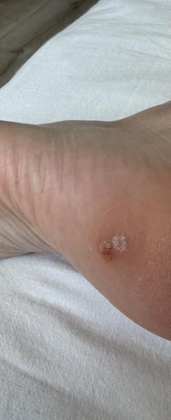 Sú bradavice na päte skutočne zahojené?