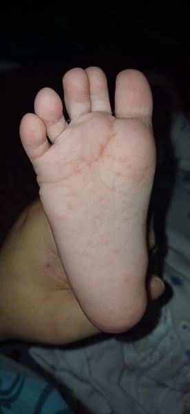 Čo má dieťa na chodidle?