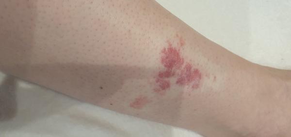 Čo mi odporúčate, keď mávam veľmi silnú kožnú reakciu po uštipnutí?