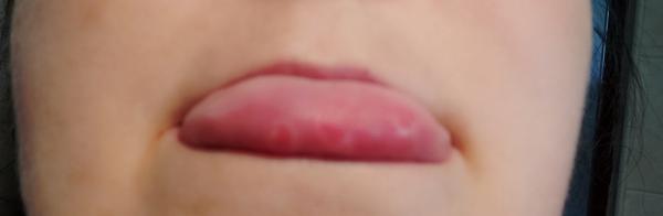 Z čoho je takýto výsyp na jazyku?