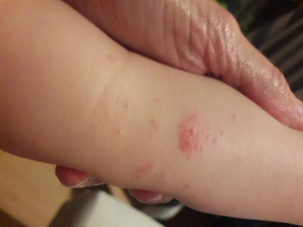 Aký kožný problém má môj syn na predlaktí?