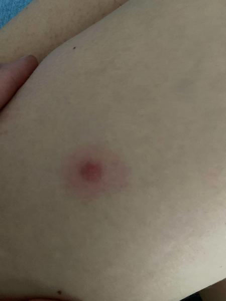 Je to vyrážka alebo uštipnutie? Skúsenosti a rady