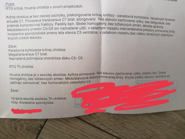 Aký je výsledok RTG Th chrbtice?