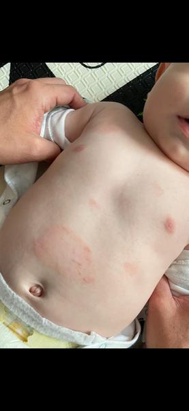 Ako liečiť ekzém, keď nechceme používať kortikoidy?