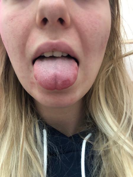 Z čoho sa mi robí opuch dlane a lézie na jazyku?