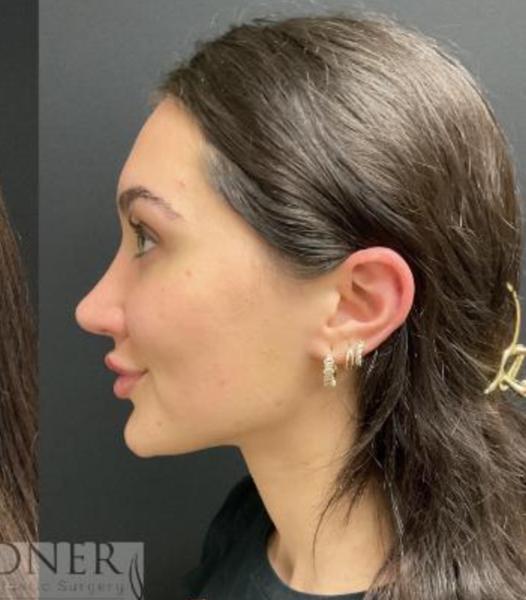 Kde nájsť dobrú plastiku nosa v Trnave?