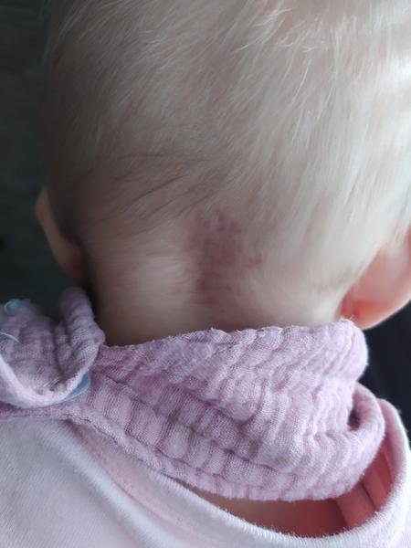 Sú takéto žilky na zátylku u 6-mesačnej dcéry v poriadku?