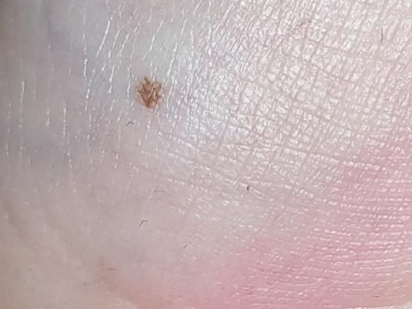 Je normálne znamienko na dlani u detí?